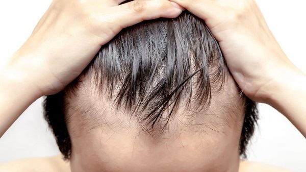 How Does Saw Palmetto Work For Hair Loss（AGA)?